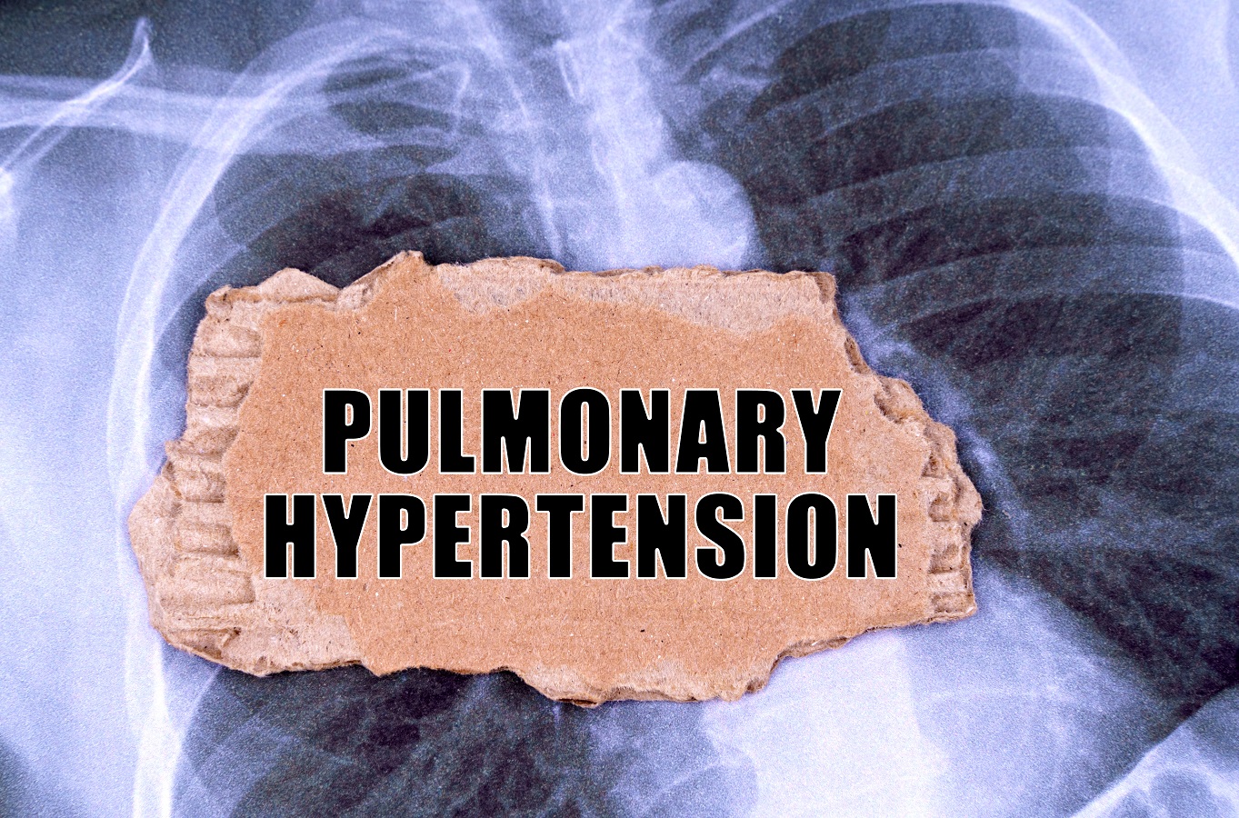 Pulmonary hypertension