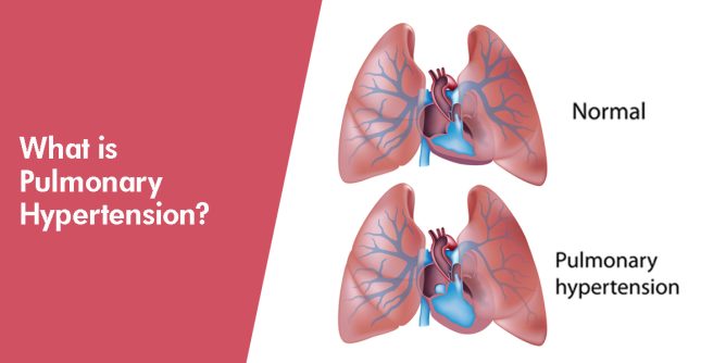 pulmonary hypertension